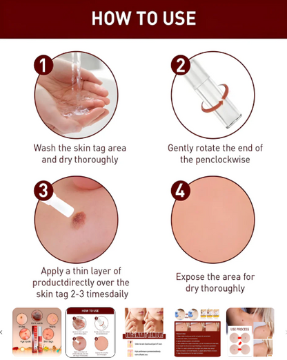Professional Skin Tag & Mole Removal Device – Flawless Skin At Home